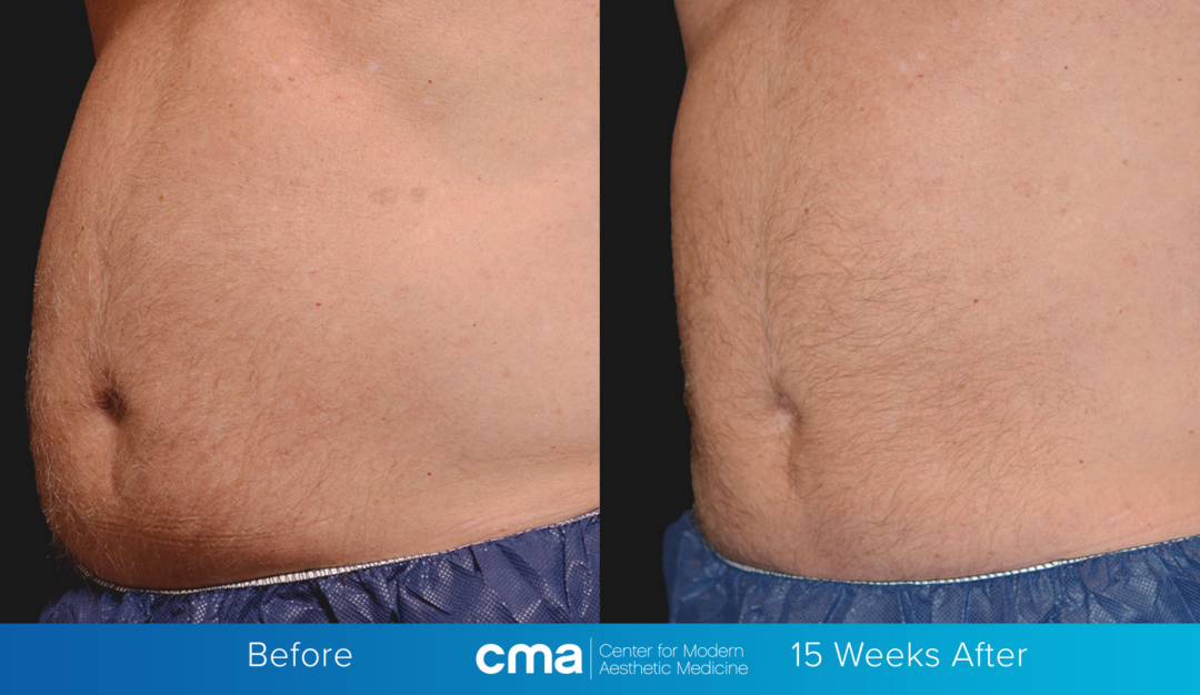 Body Sculpting Jacksonville FL Advanced Body Sculpting Services CMA