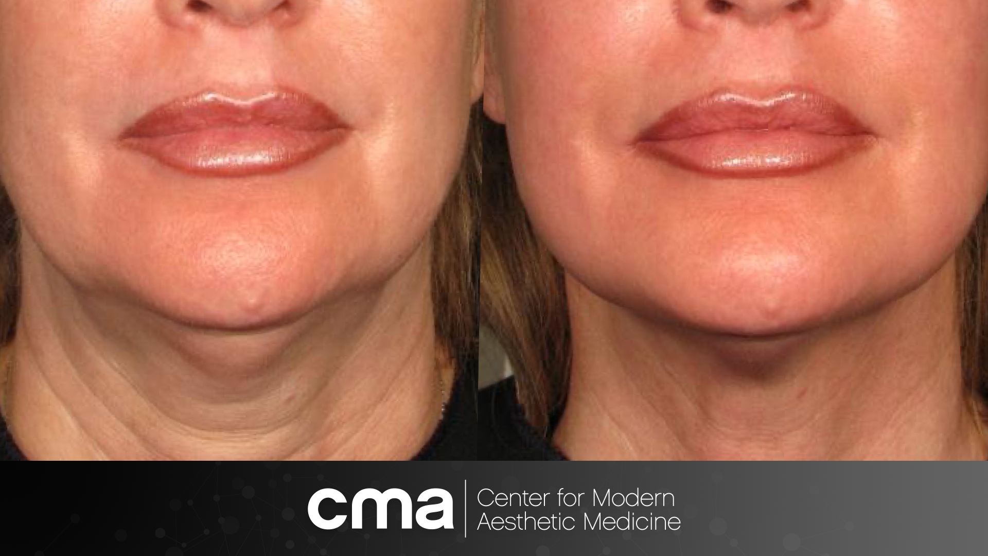 Lip Fillers Jacksonville FL CMA Center for Modern Aesthetic Medicine